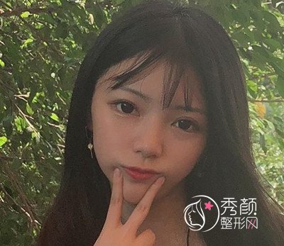深圳恩吉娜眼部手术+隆鼻案例分享。
