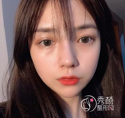深圳恩吉娜眼部手术+隆鼻案例分享。