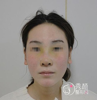 北京谁做鼻子好?北京京民王志坚隆鼻案例分享。