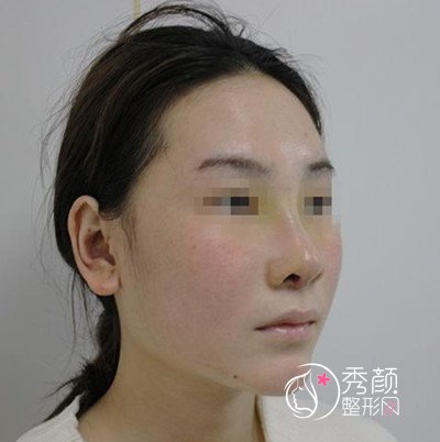 北京谁做鼻子好?北京京民王志坚隆鼻案例分享。