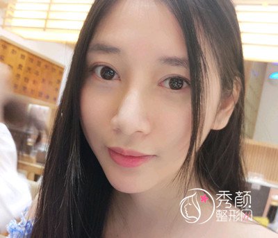 广州紫馨曹仁昌双眼皮修复案例分享。