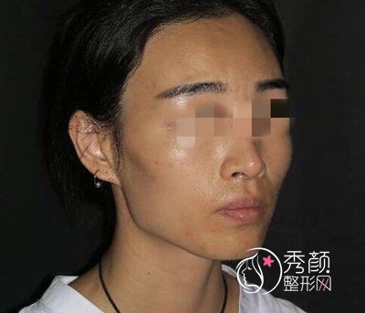 北大人民医院彭喆磨骨改脸型案例，分享自己的心路历程！