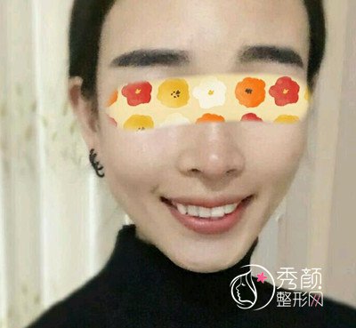 北大人民医院彭喆磨骨改脸型案例，分享自己的心路历程！