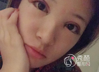 上海容妍柴云割双眼皮怎么样,眼部手术案例分享。