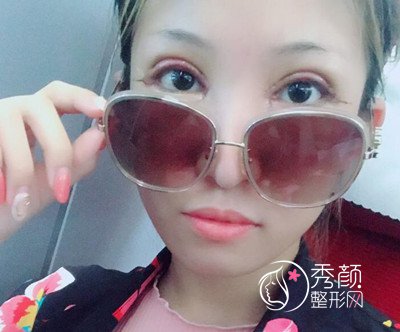 上海容妍柴云割双眼皮怎么样,眼部手术案例分享。