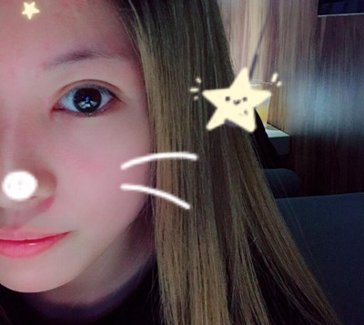 上海容妍柴云割双眼皮怎么样,眼部手术案例分享。