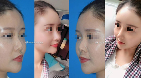 <b>牛勇敢做鼻子怎么样,贵不贵,价格案例分享。</b>