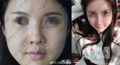<b>上海九院张盈帆做鼻子怎么样,价格案例分享。</b>