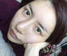 上海九院张盈帆鼻修复案例分享。