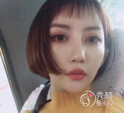 上海九院张盈帆鼻修复案例分享。