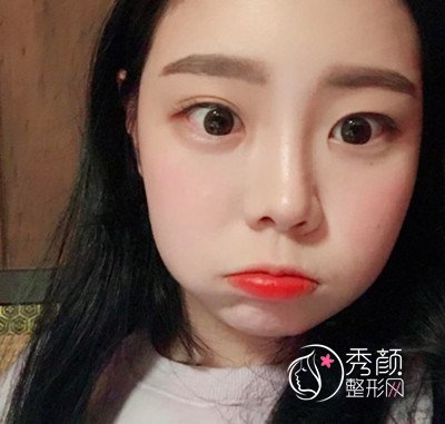 上海韩镜赵越全肋鼻部手术案例分享。