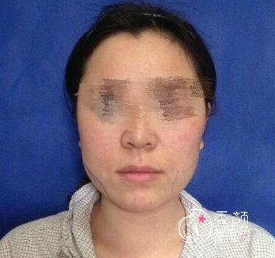 北京八大处解芳下颌角整形案例分享。