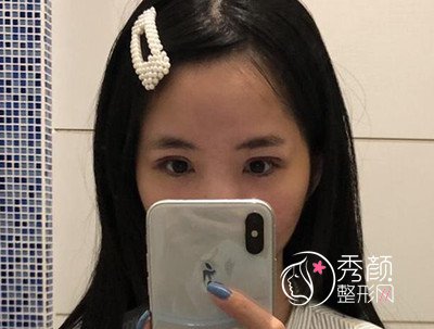 上海九院苏薇洁割双眼皮怎么样,苏薇洁割双眼皮案例。