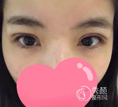上海九院苏薇洁割双眼皮怎么样,苏薇洁割双眼皮案例。