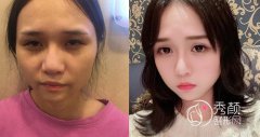 <b>李志海颧骨内推手术怎么样,颧骨内推案例及价格。</b>