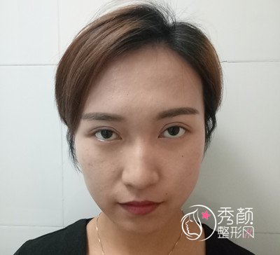 北京韩啸门诊白永辉双眼皮修复怎么样,双眼皮修复案例。
