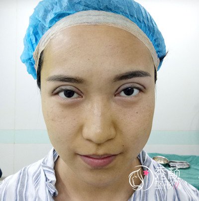 北京韩啸门诊白永辉双眼皮修复怎么样,双眼皮修复案例。