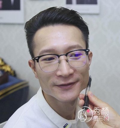 北京黄大勇男生下颌角磨骨案例分享。