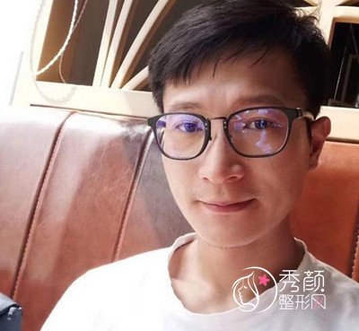 北京黄大勇男生下颌角磨骨案例分享。