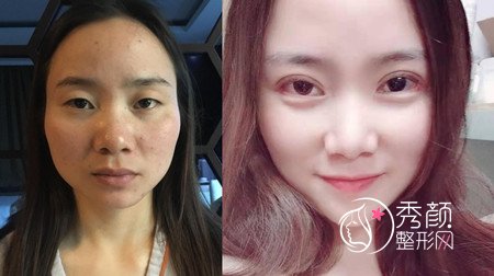 上海艺星唐毅双眼皮修复怎么样,价格案例分享。
