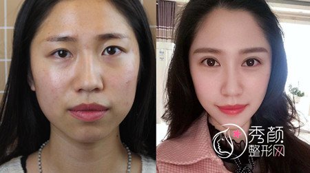 上海艺星唐毅双眼皮修复怎么样,价格案例分享。