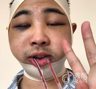 上海九院袁捷男士下颌角整形案例