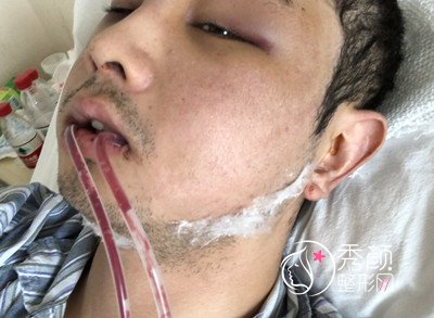 上海九院袁捷男士下颌角整形案例