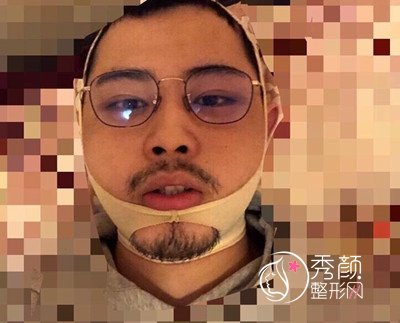 上海九院袁捷男士下颌角整形案例