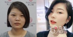 长沙美之峰丁翔做鼻子怎么样,价格案例分享。