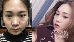 <b>韩嘉毅做鼻子到底怎样，韩嘉毅做鼻子多少钱?</b>