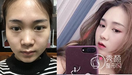 韩嘉毅做鼻子到底怎样,韩嘉毅做鼻子多少钱?