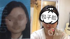 广州南方医院磨骨怎么样?哪个医生好?磨骨案例。