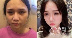<b>上海华美李志海和上海时光何晋龙哪个磨骨做得好,价格案例对比。</b>