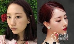 上海哪家医院隆鼻好,首尔丽格和华美哪个好,价格案例对比。