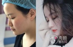 长沙贝美熊宜文做鼻子怎么样,价格 案例