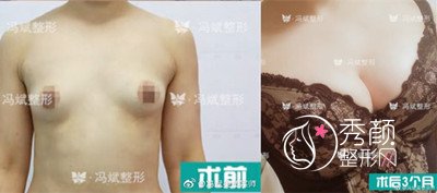 北京东方和谐冯斌自体脂肪隆胸案例。