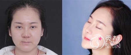 广州隆鼻谁好?广州徐士亮肋骨鼻做的怎么样,价格 案例