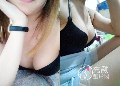 上海薇琳张怀军曼托假体隆胸案例。