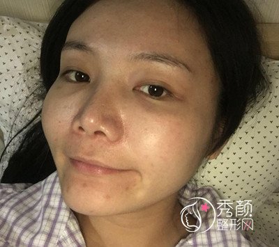 上海华美李志海颧弓降低案例。