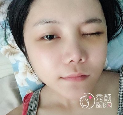 上海华美李志海颧弓降低案例。