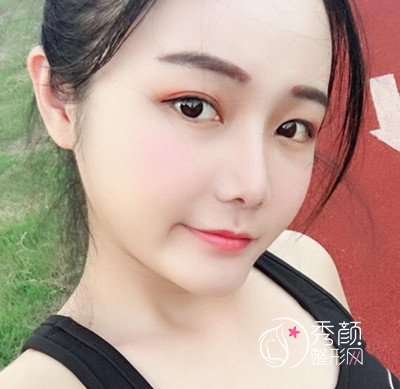 上海华美李志海颧弓降低案例。