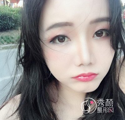 上海华美李志海颧弓降低案例。