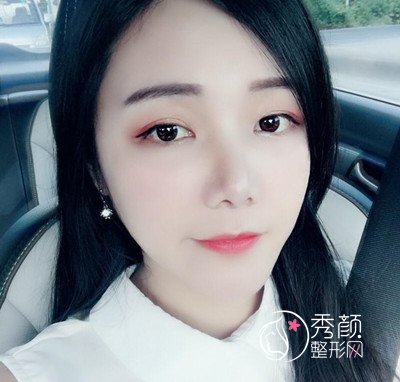 上海华美李志海颧弓降低案例。