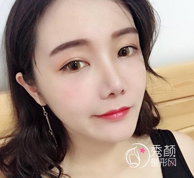 上海华美李志海颧弓降低案例。