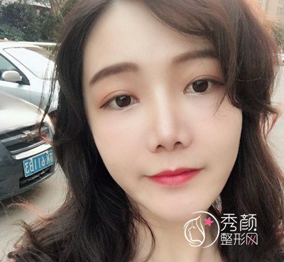 上海华美李志海颧弓降低案例。