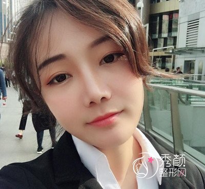 上海华美李志海颧弓降低案例。