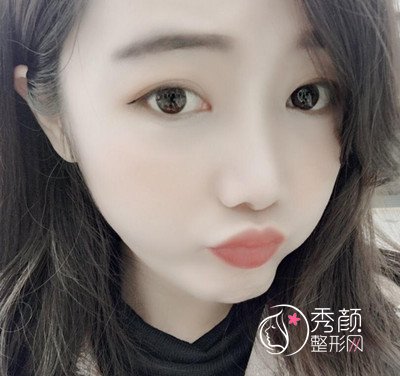 上海华美李志海颧弓降低案例。