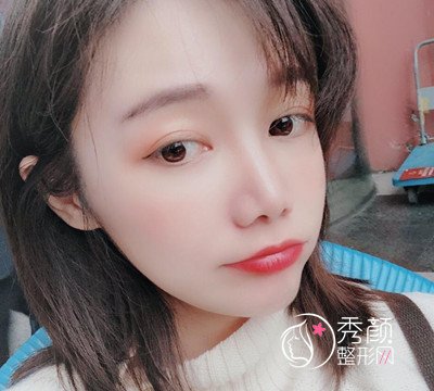 上海华美李志海颧弓降低案例。