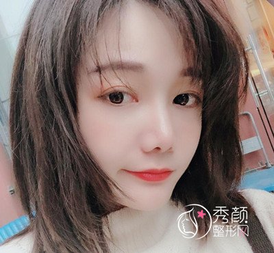 上海华美李志海颧弓降低案例。