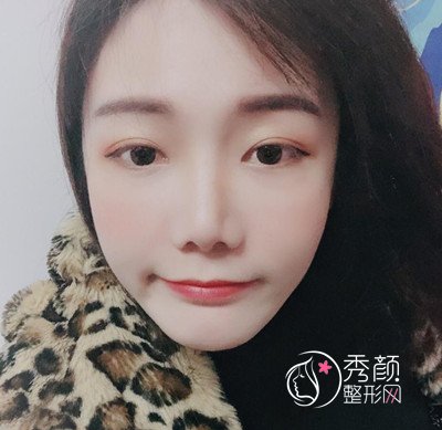 上海华美李志海颧弓降低案例。